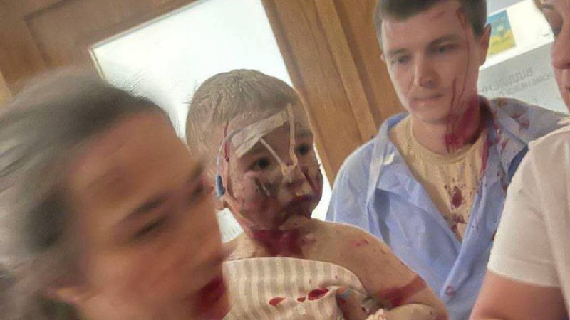 Un niño con sangre y polvo en el Hospital Infantil de Kiev el 8 de julio, una de las fotos más difundidas del ataque