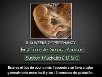 Aborto quirúrgico, primer trimestre